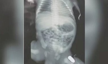 Adolescente faz parto de emergência após ser baleada; bebê foi atingido na perna